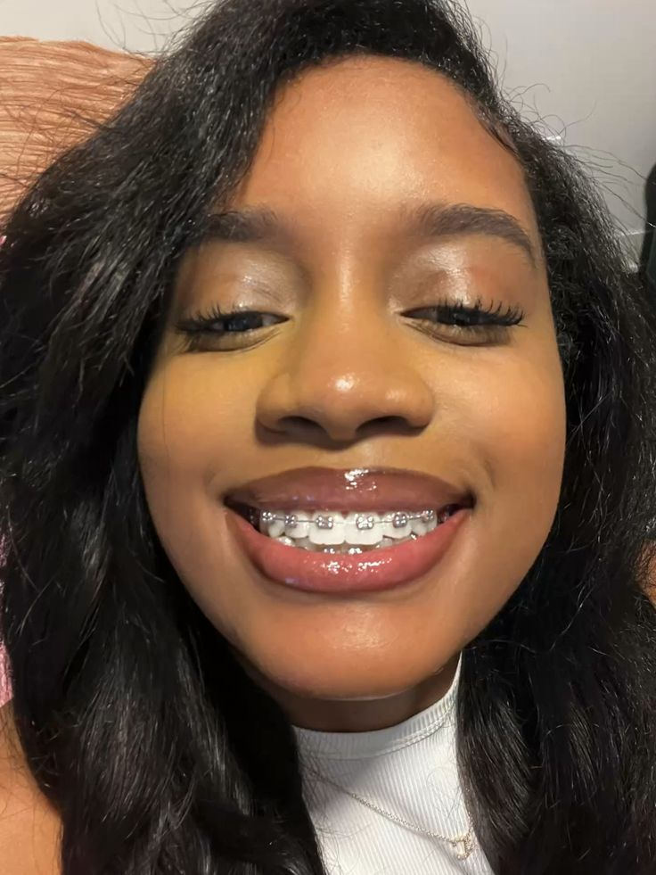 Fixed Orthodontics (Braces)