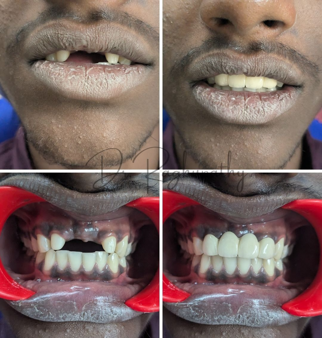 Fixed Dentures (Crowns & Bridges)