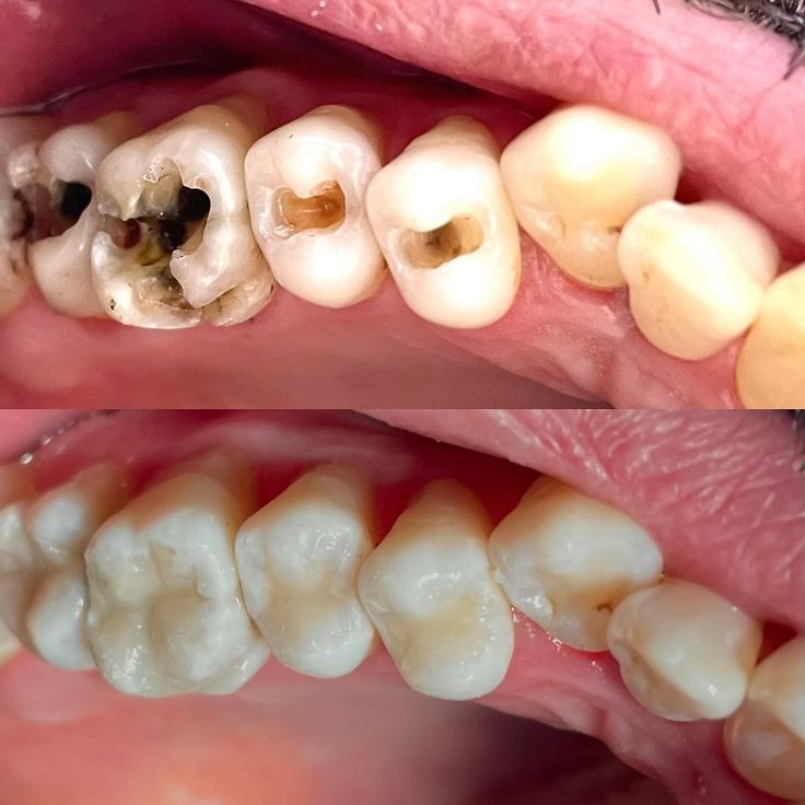 Before and after