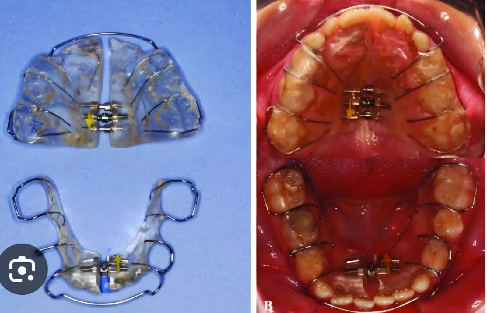 Custom expansion appliance — lab and in-mouth view